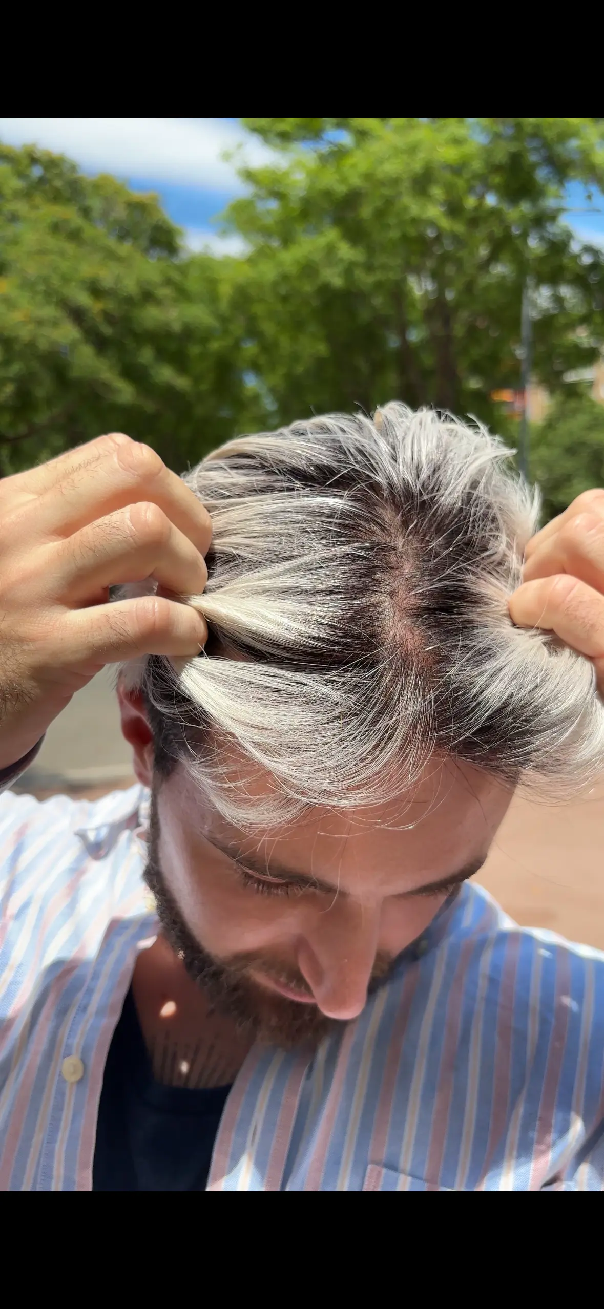 Prótesis Capilares Personalizadas en Barcelona